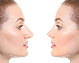 Rinoplastia: profil înainte și după operație