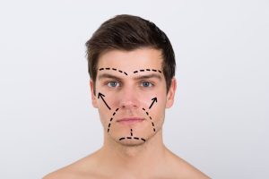 Bărbat cu marcaje pe față pentru o intervenție facială
