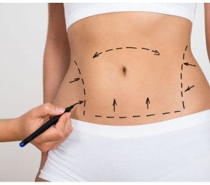 Abdomen marcat pentru o intervenție după naștere