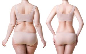 Siluetă înainte și după lipoaspirație